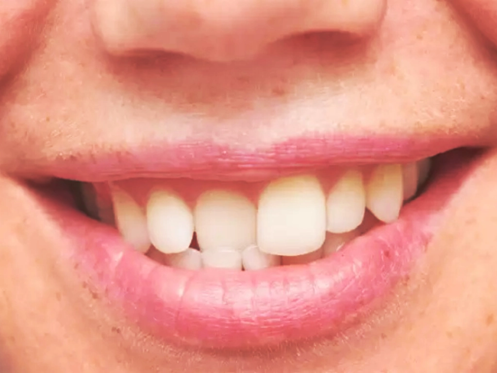 Răng vĩnh viễn dễ mọc lệch khi bé thiếu răng